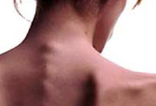 Eating Disorders Treatment